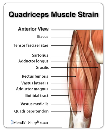 quadricep muscle pull or strain