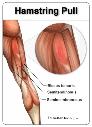 Pulled Muscle 76