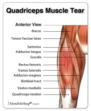How do you know if you have pulled a muscle?