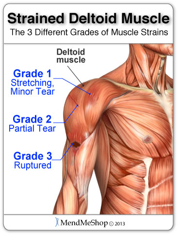 How Long Does It Take For A Pulled Back Muscle To Heal 119