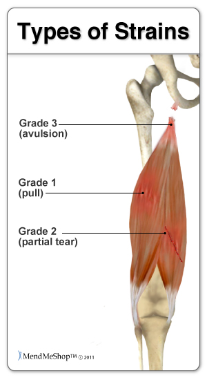 What are some good treatments for a torn quad muscle?