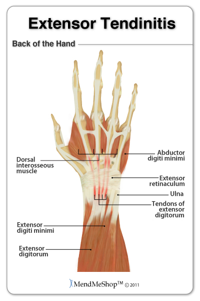 wrist extensor tendonitis icd 10